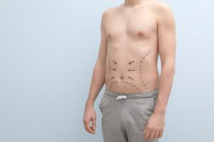 The Truth About Lymphatic Massage 3 male liposuction patient with marks on his midsection