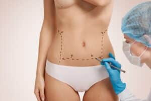 The Truth About Lymphatic Massage 2 liposuction marking by the surgeon