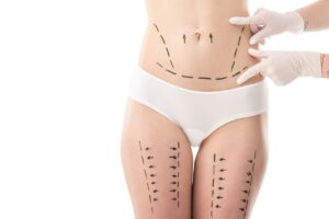 The Truth About Lymphatic Massage 1 surgeon wearing white gloves completed liposuction markings on patient