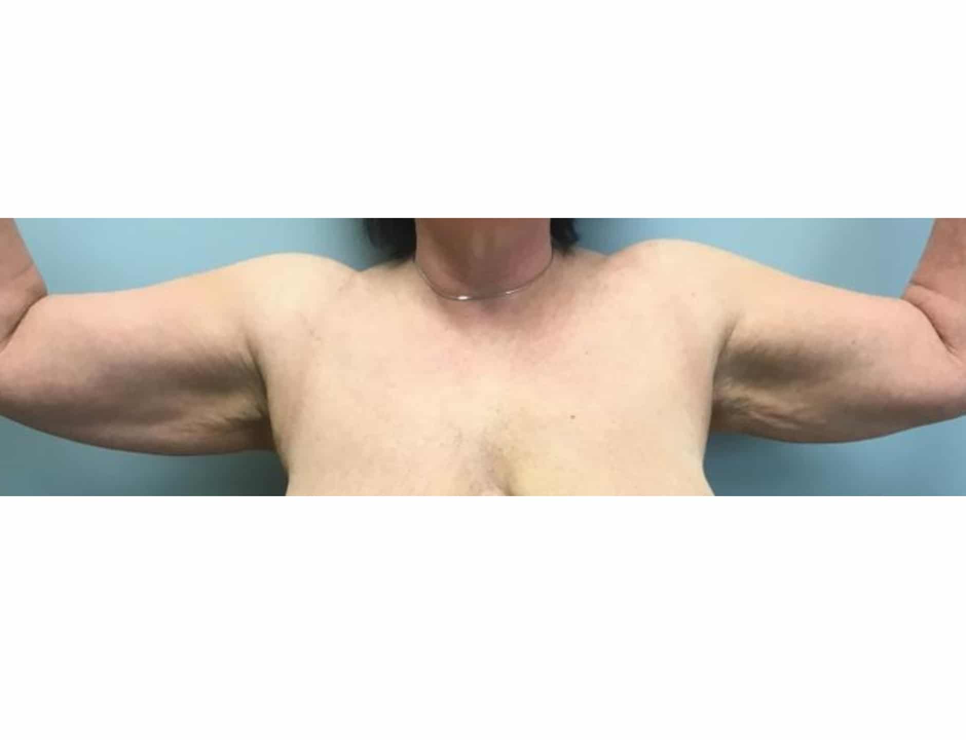 Brachio BA 02 Brachio BA 02