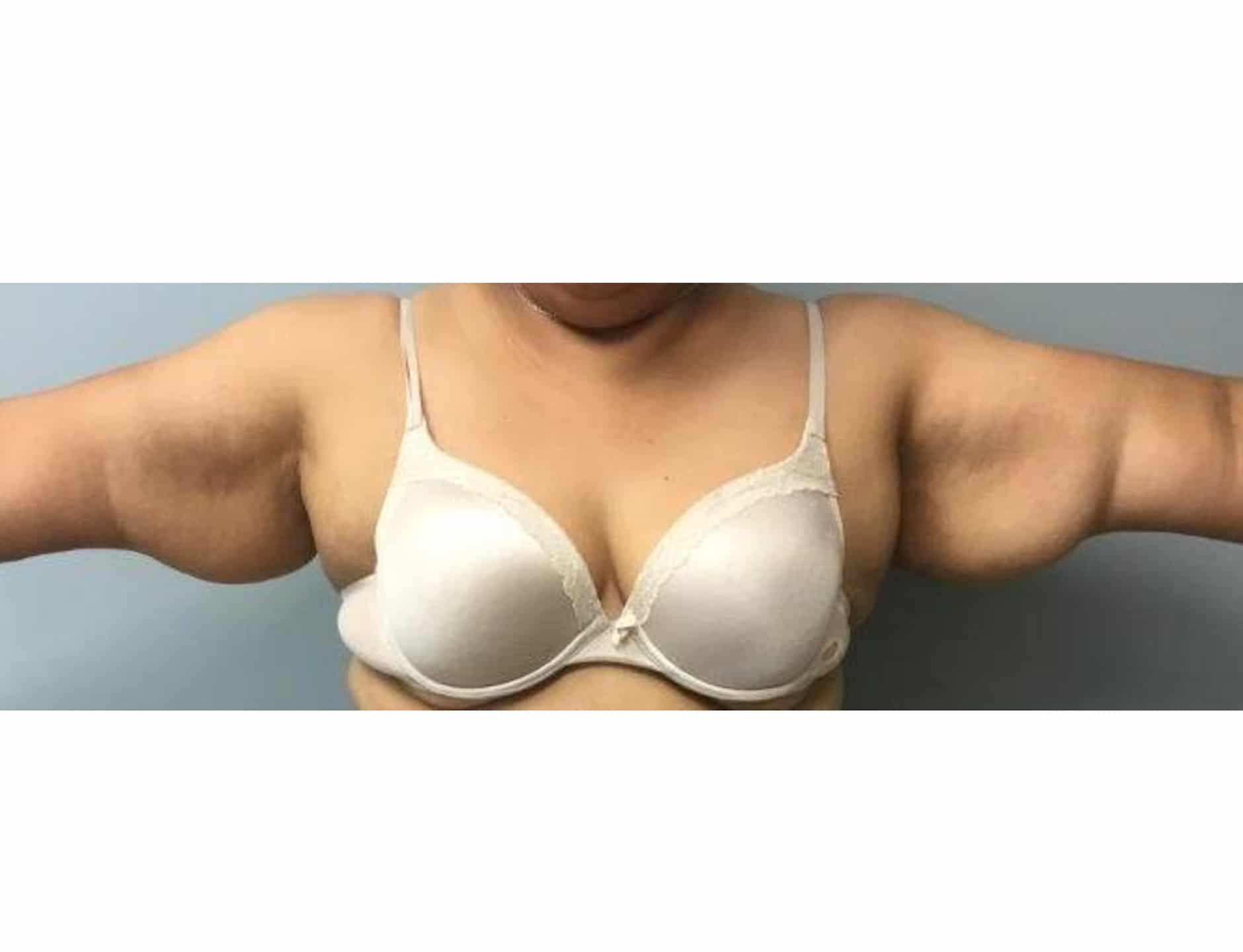 Brachio BA 03 Brachio BA 03