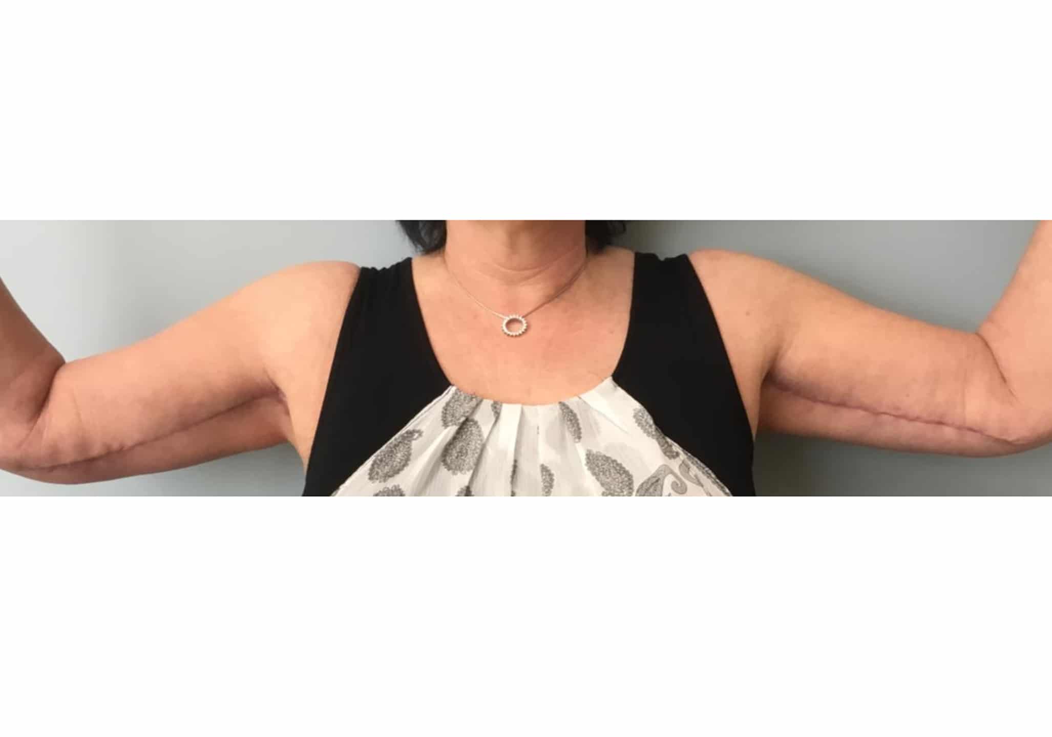 Brachio BA 05 Brachio BA 05