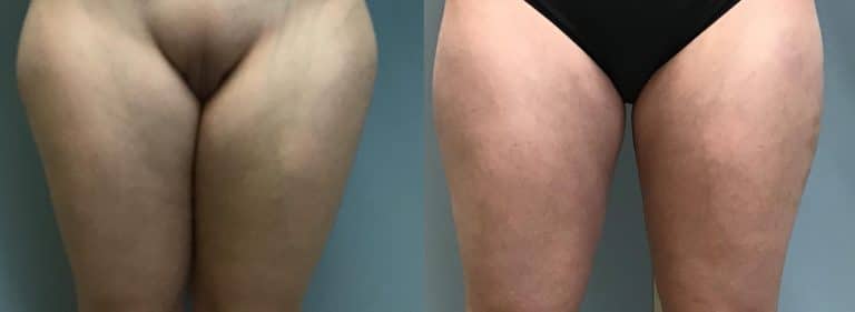 Thigh Liposuction 8 Thighs Lipo 1