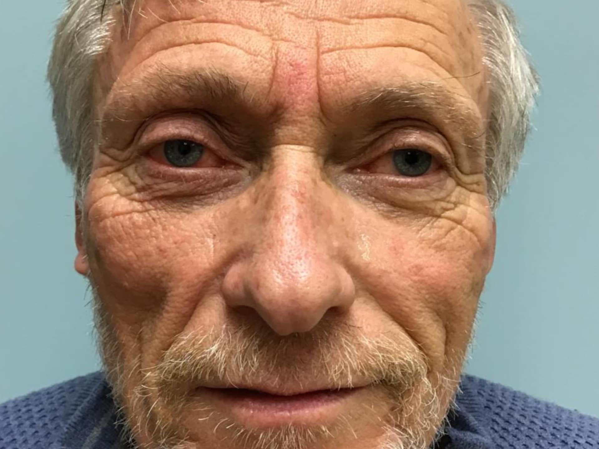 fat graftinf face 1 fat graftinf face 1