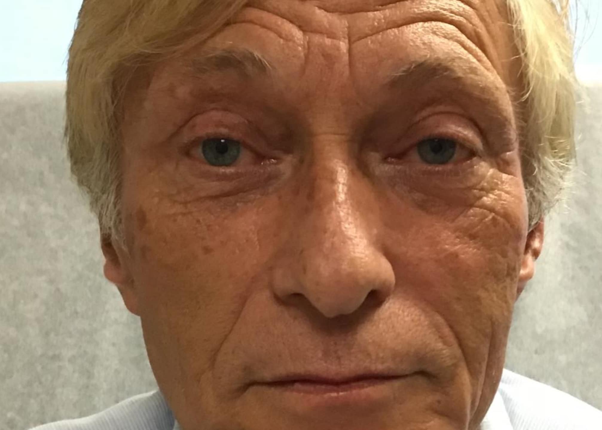 fat graftinf face 2 fat graftinf face 2