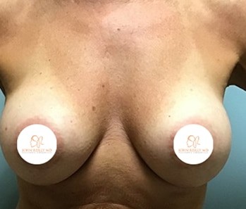 breast augm ba JR MD 05