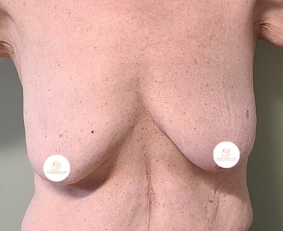 breast lift john reilly md 03 breast lift john reilly md 03