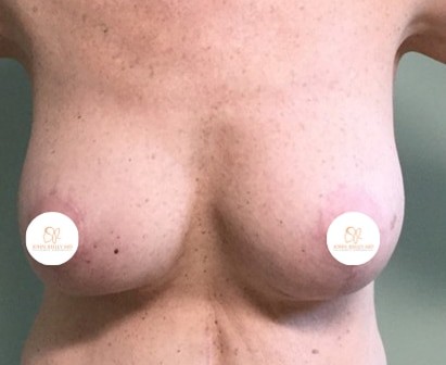 breast lift john reilly md 04 breast lift john reilly md 04