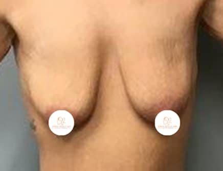 breast lift john reilly md 05 breast lift john reilly md 05