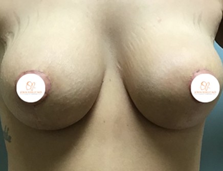 breast lift john reilly md 06 breast lift john reilly md 06