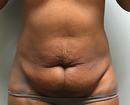 abdominoplasty BA main 01 abdominoplasty BA main 01