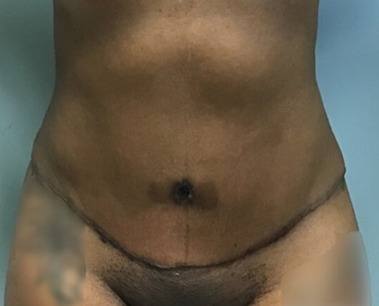 abdominoplasty BA main 02 abdominoplasty BA main 02