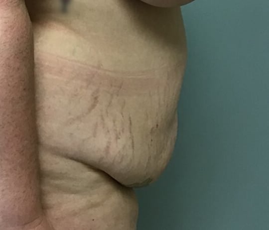 abdominoplasty BA main 03 abdominoplasty BA main 03