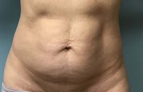 abdominoplasty BA main 05 abdominoplasty BA main 05