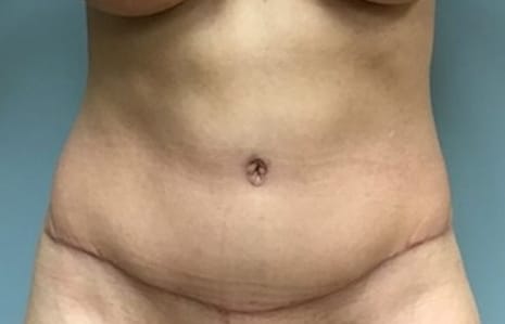 abdominoplasty BA main 06 abdominoplasty BA main 06