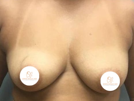 BA Breast Lift 01