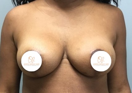BA Breast Lift 08