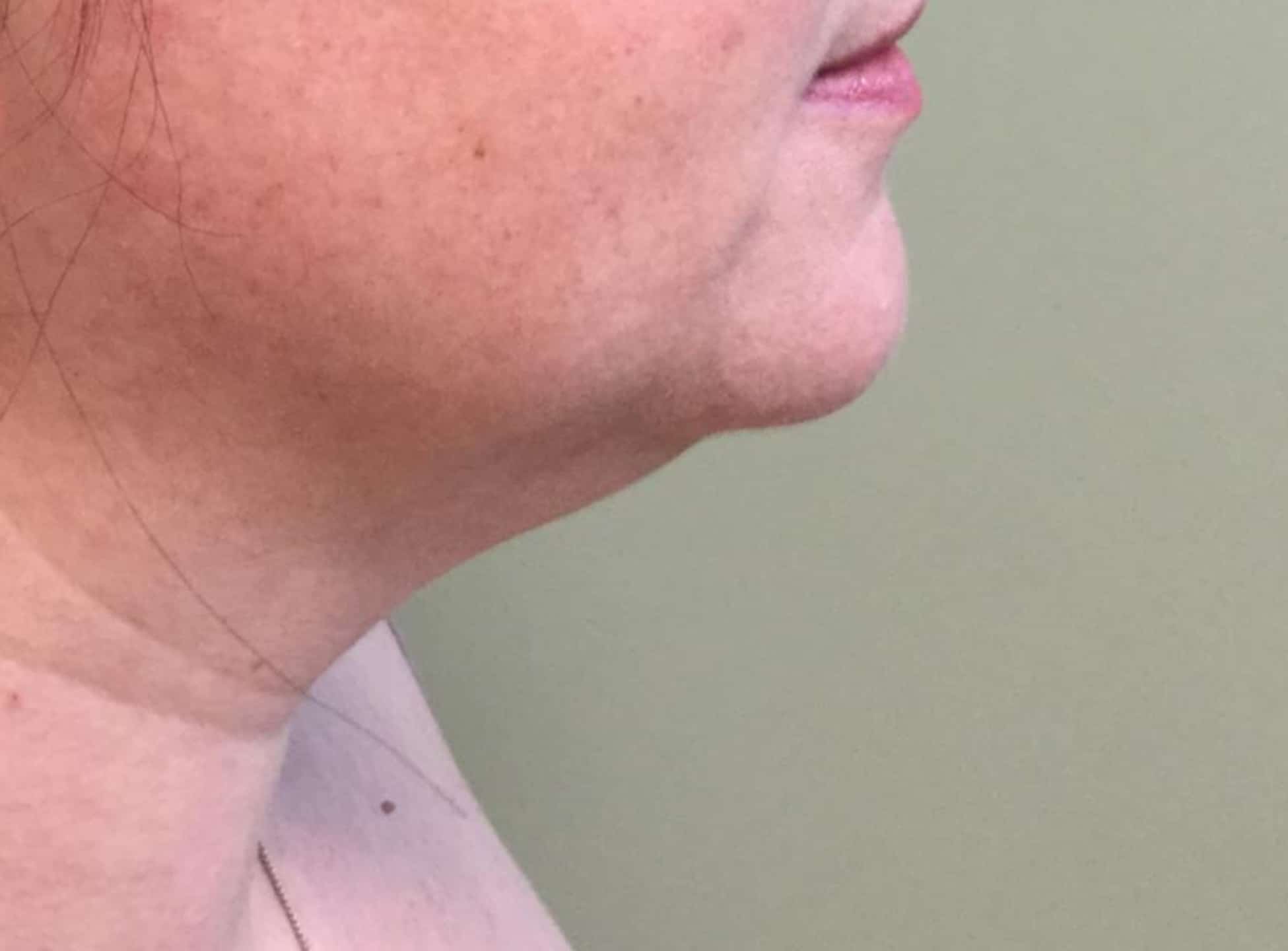 BA Chin Lipo 01