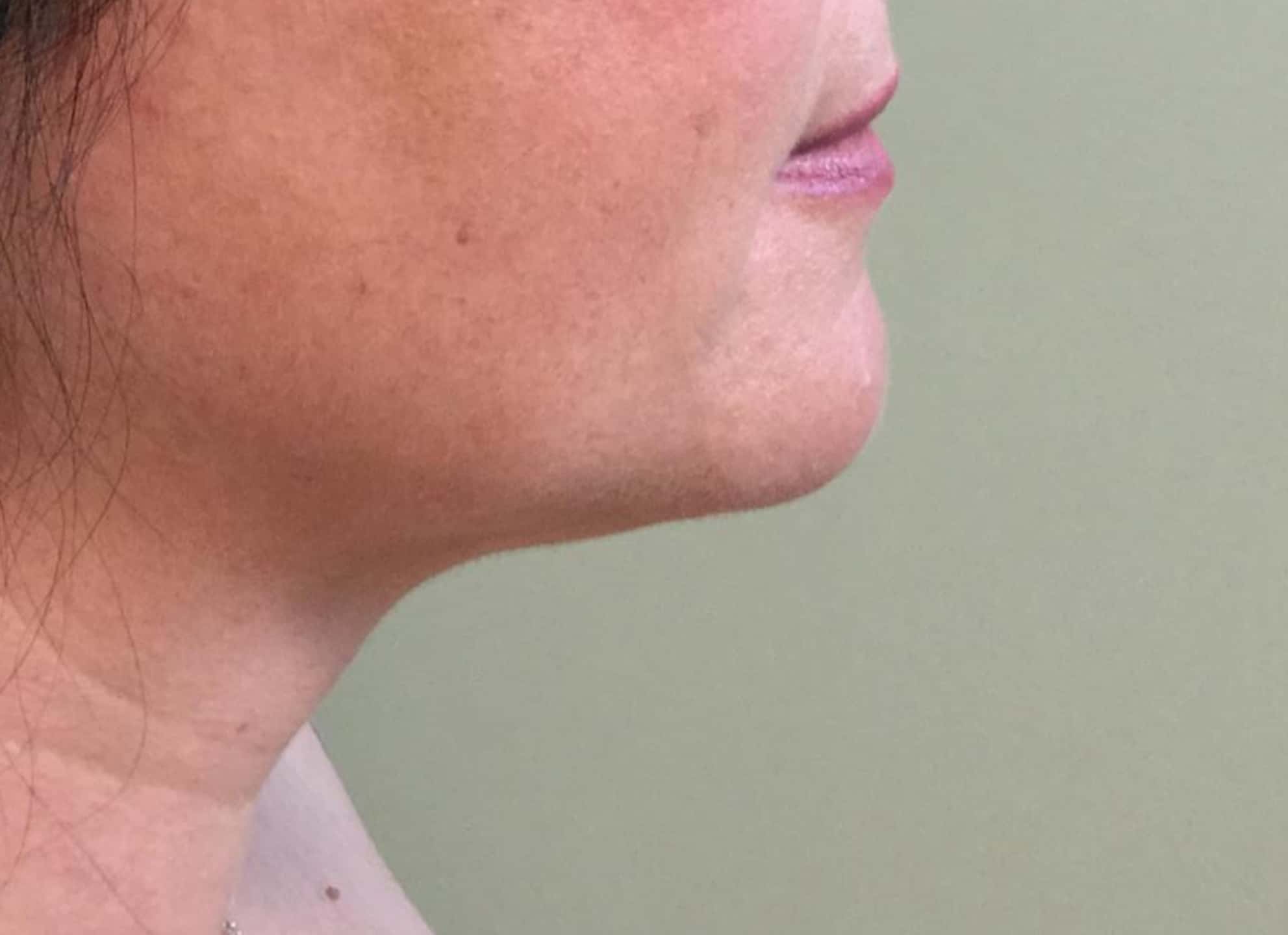 BA Chin Lipo 02