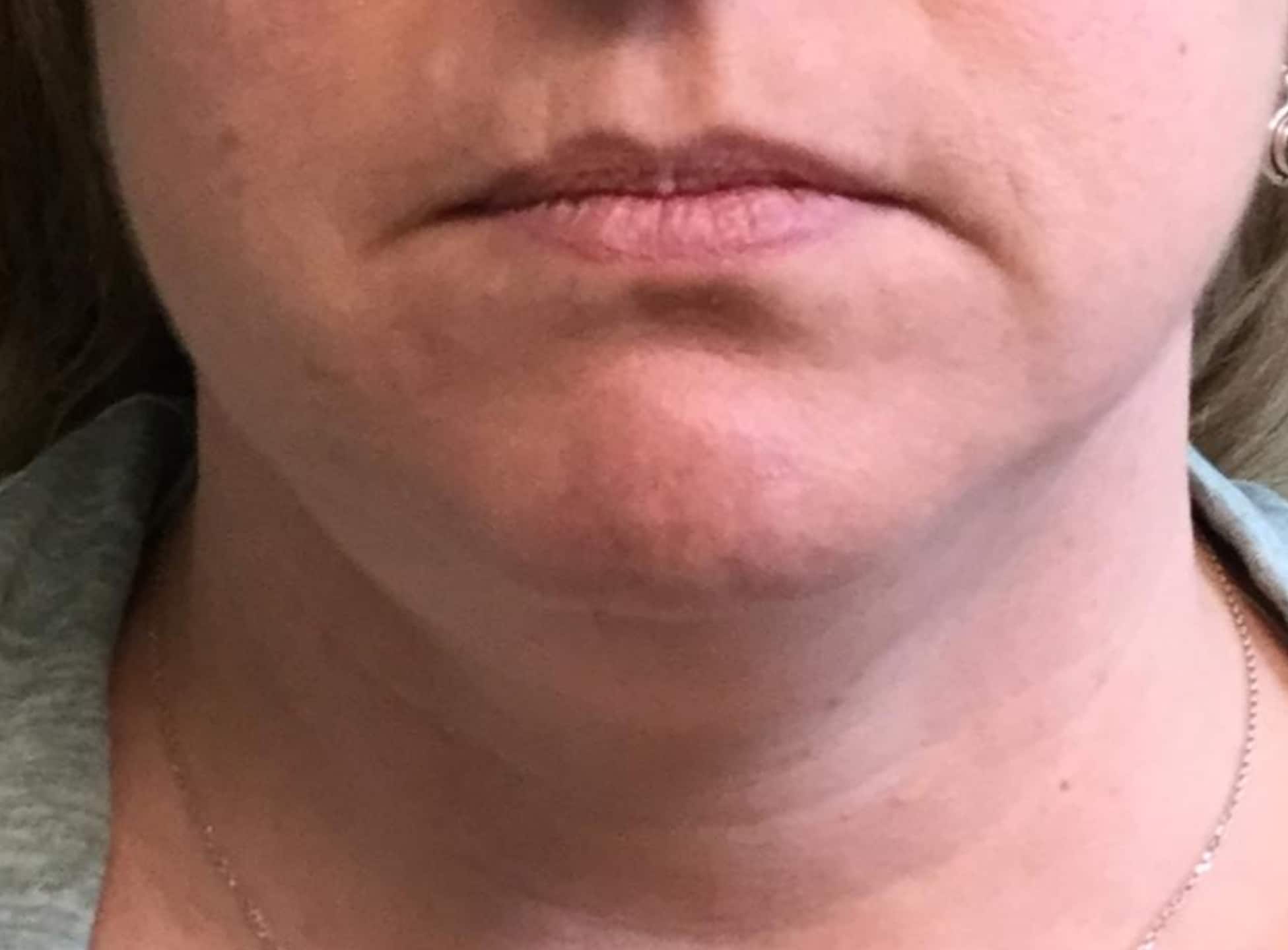 BA Chin Lipo 03