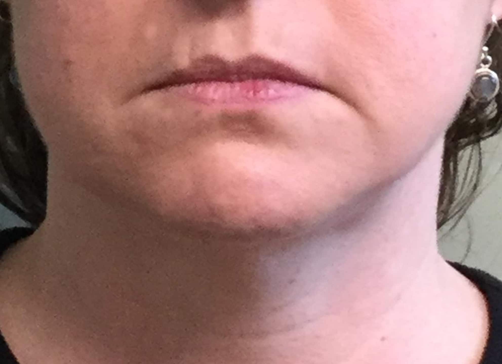 BA Chin Lipo 04