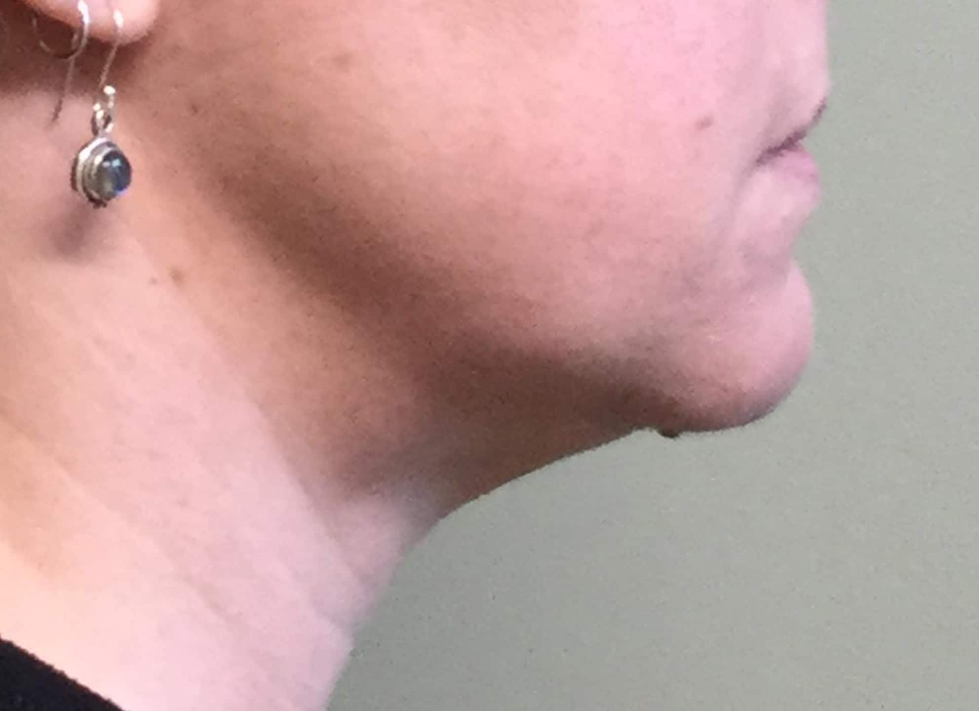 BA Chin Lipo 06