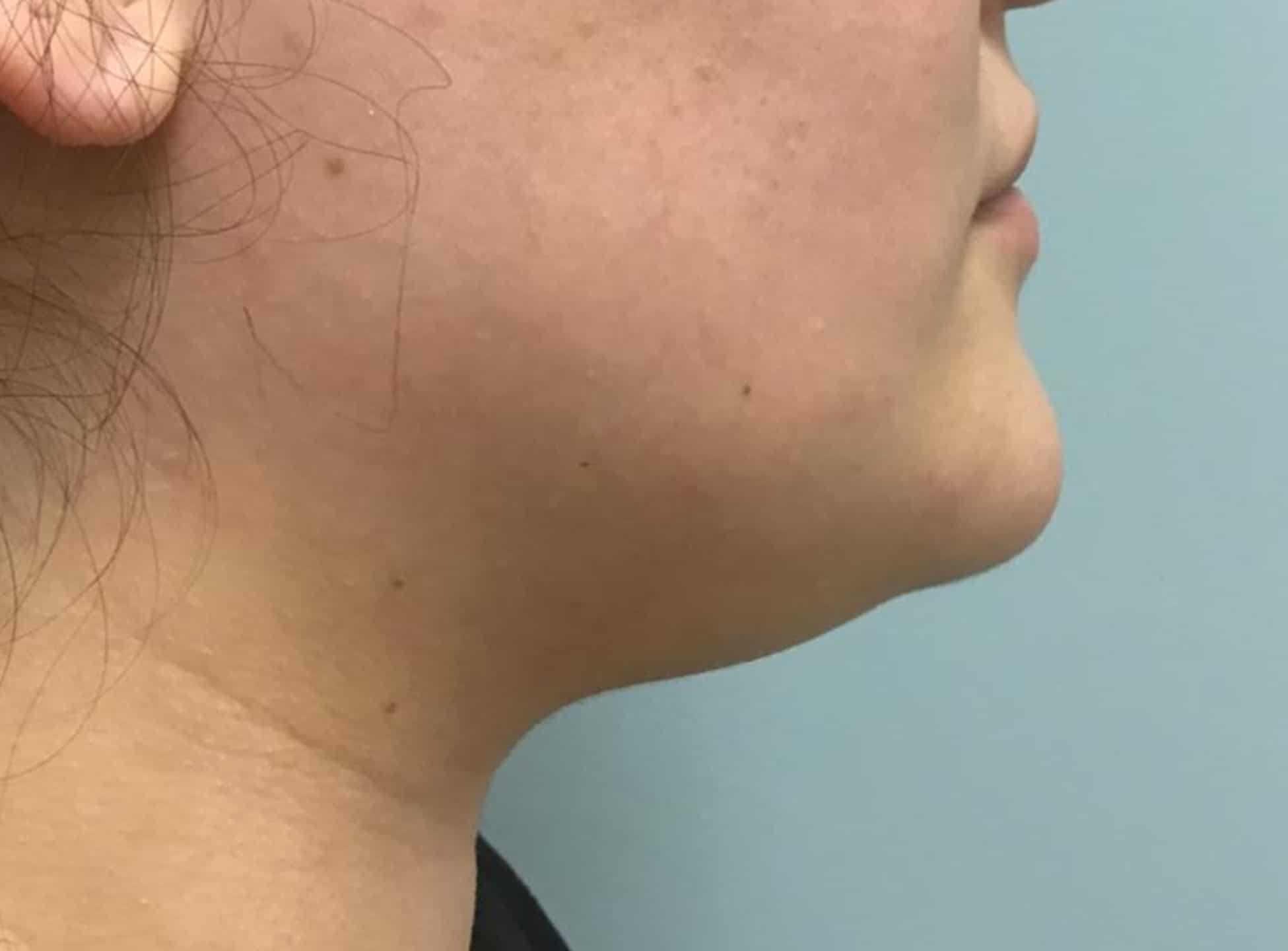BA Chin Lipo 07