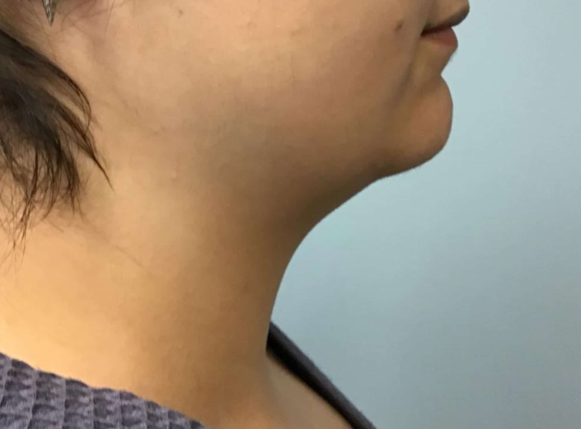 BA Chin Lipo 09