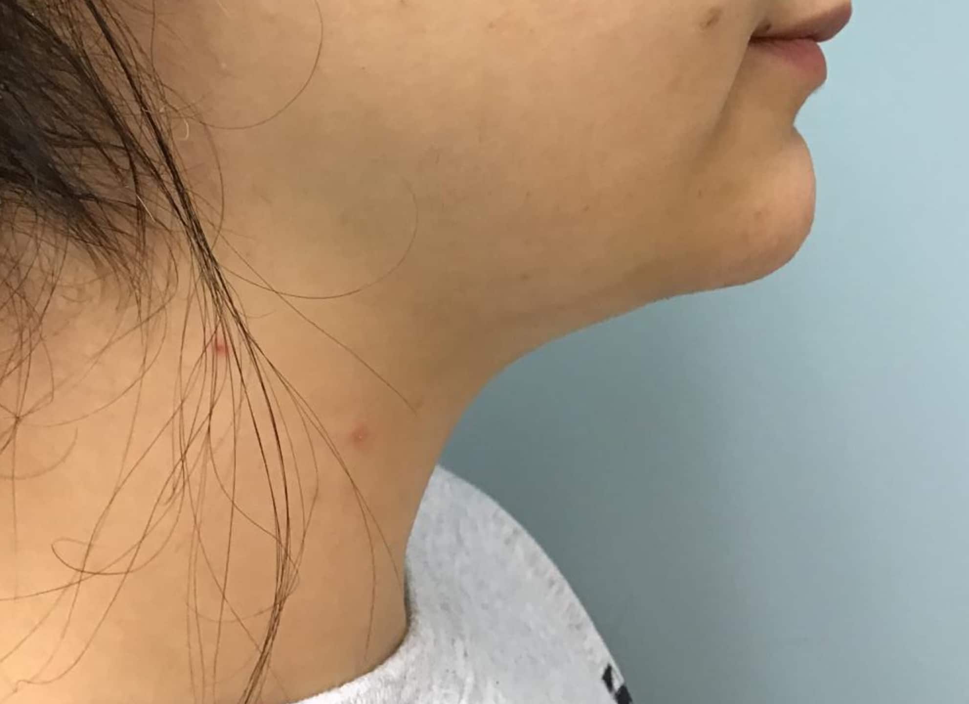 BA Chin Lipo 10