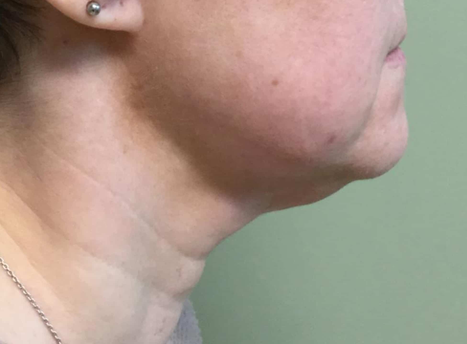 BA Chin Lipo 11