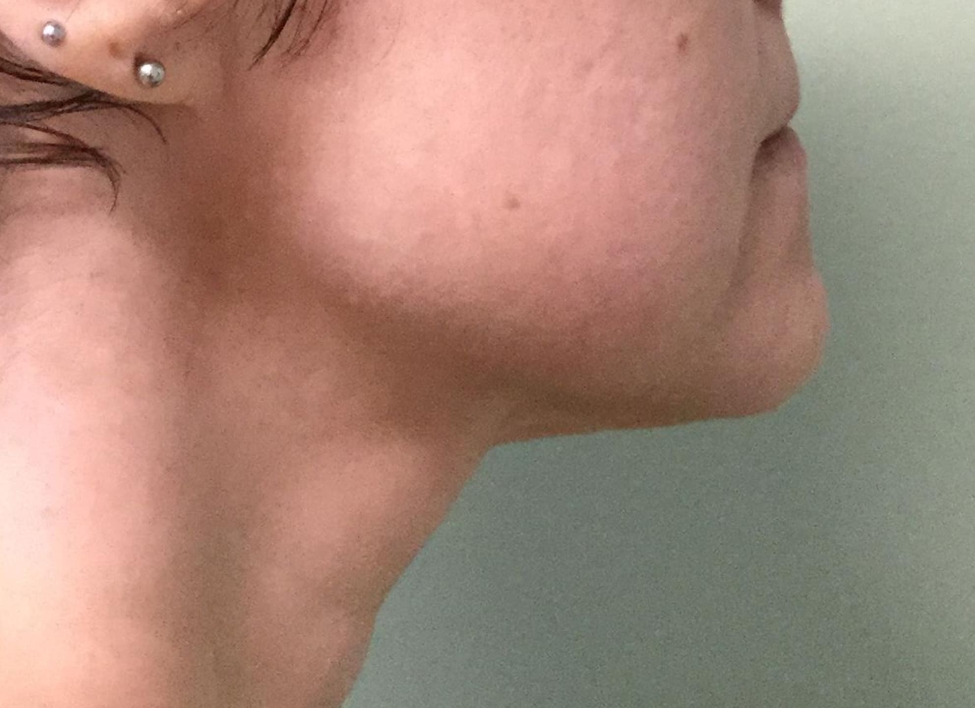 BA Chin Lipo 12