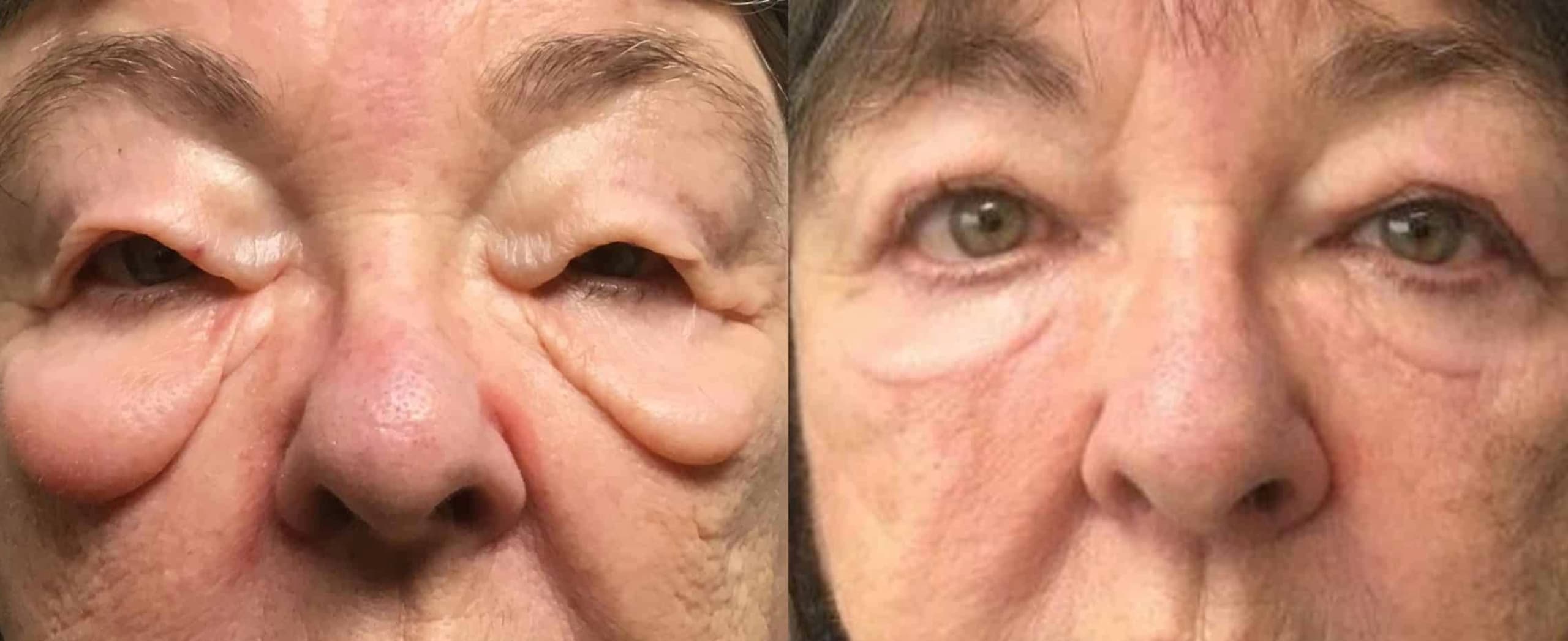 Blepharoplasty 13 Bleph-08-scaled (cropped)