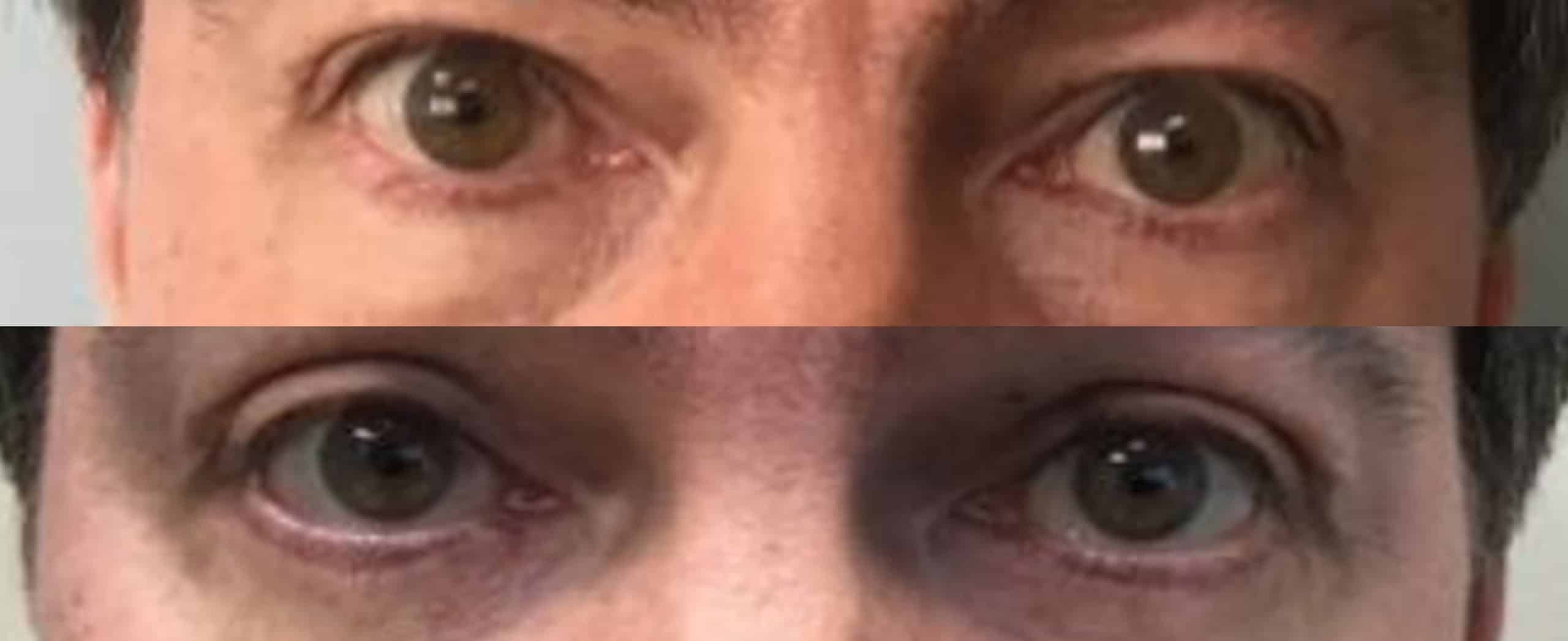 Male Blepharoplasty 8 Bleph-05-scaled.jpg