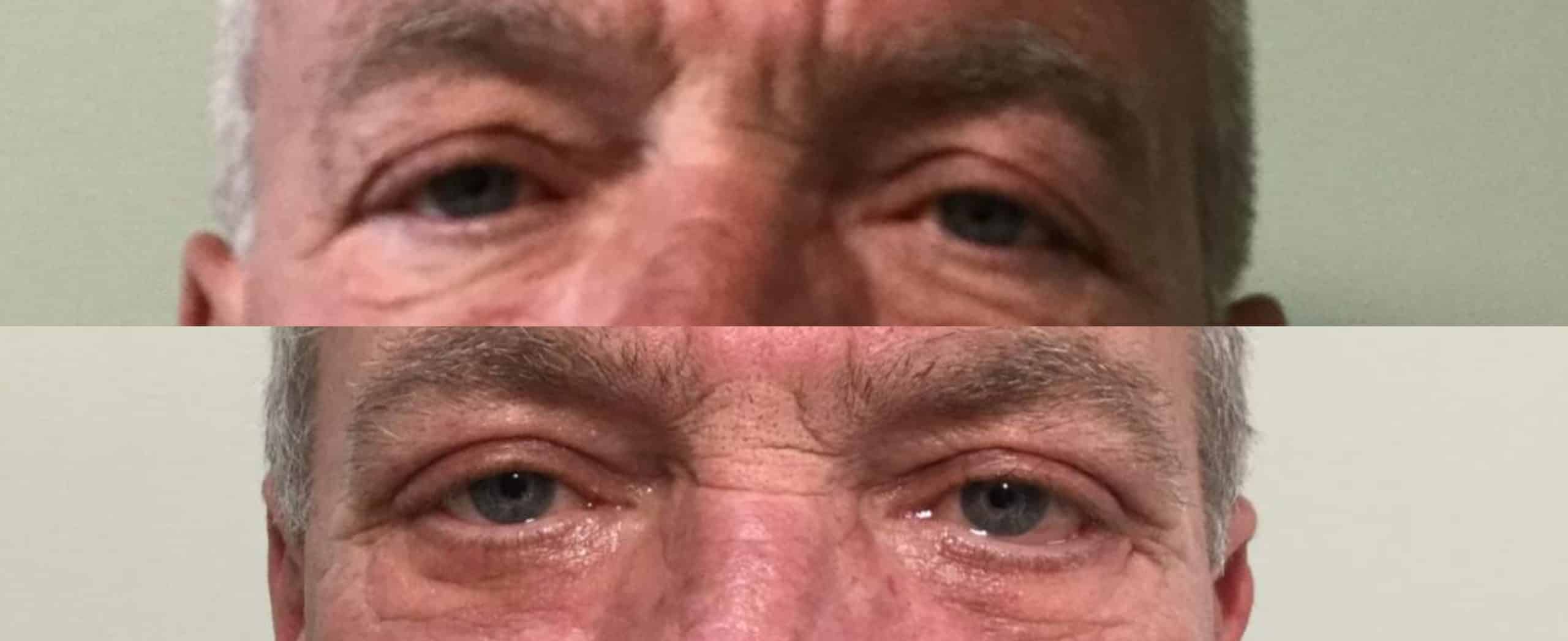 Male Blepharoplasty 9 Bleph-06-scaled.jpg