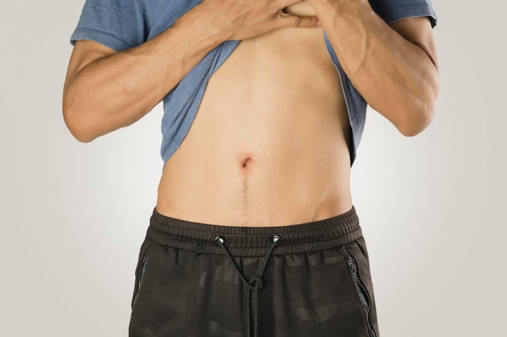 Male Liposuction Connecticut