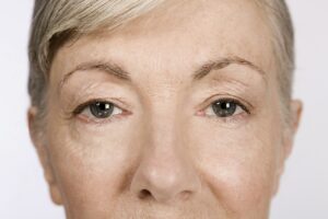 What Is the Difference Between Upper and Lower Blepharoplasty? 2 close up of a senior woman's eye