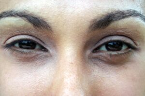What Is the Difference Between Upper and Lower Blepharoplasty? 3 close up of woman's eyes