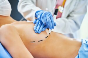 What Are the Different Types of Top Surgery? 3 surgeon marking patient for surgery