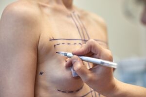 What Are the Different Types of Top Surgery? 1 surgical markings pre operation