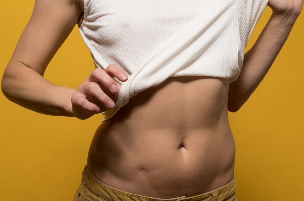 tummy tuck revision recovery
